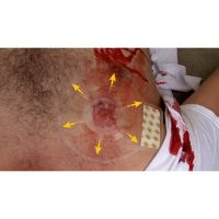 H*Vent Chest Seal Twinpack  aresmaxima.com